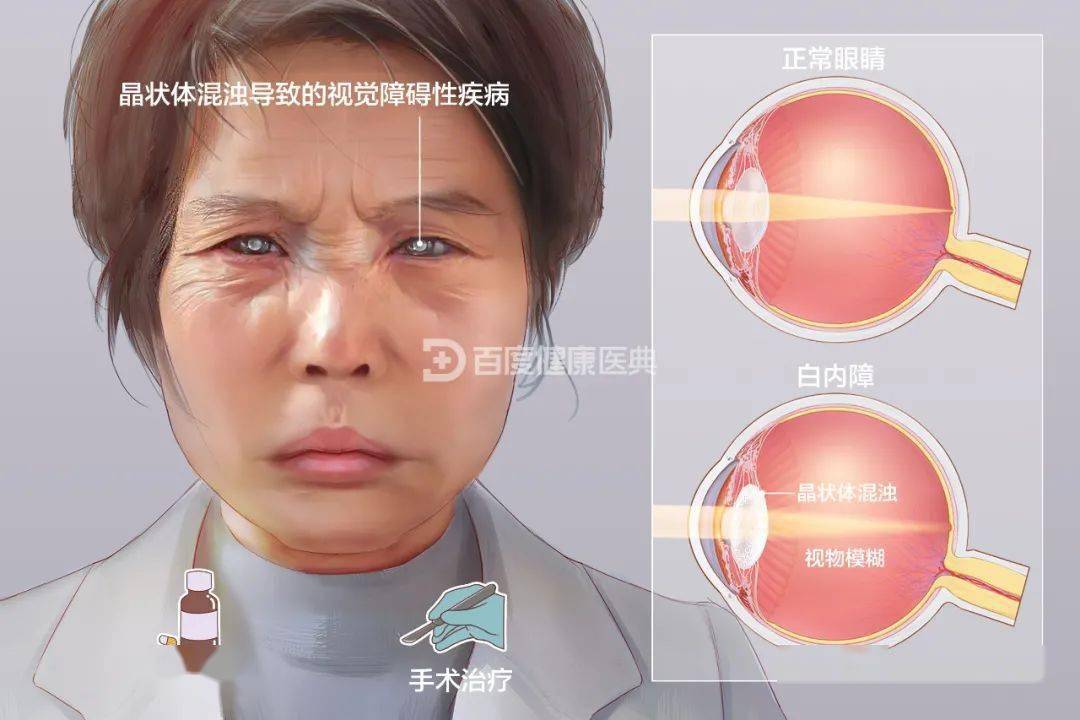 近视了打游戏要带眼镜吗_打手机游戏近视_近视对打游戏有影响吗