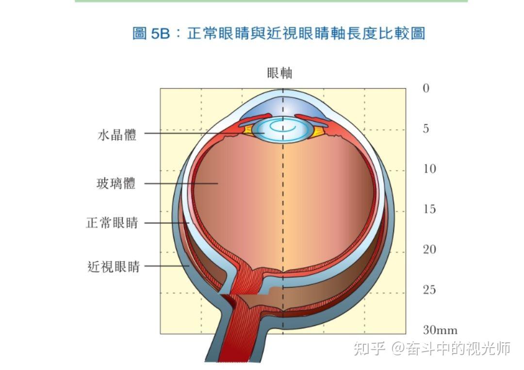 近视了打游戏要带眼镜吗_打手机游戏近视_近视对打游戏有影响吗